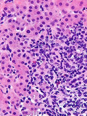 Autoimmune hepatitis - cropped - very high mag.jpg