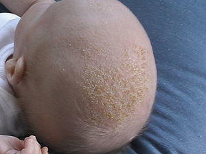Baby With Cradle Cap.jpg