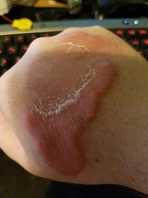 Erythema elevatum diutinum on hand.jpg