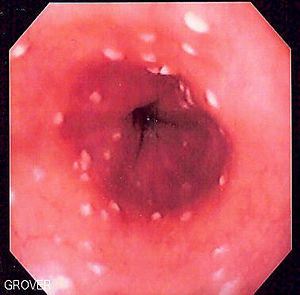 Esophageal candidiasis.jpg