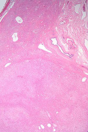 Hepatic adenoma low mag.jpg