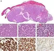Micrographs of a typical merkel cell carcinoma.jpg