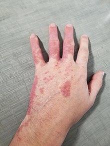 PortWineStainHand.jpg