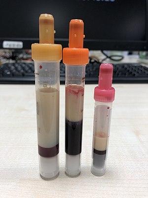 Hypertriglyceridämie.jpg