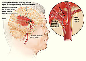 Stroke hemorrhagic.jpg