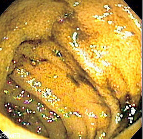 Double balloon normal SB mucosa.jpg