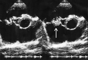 Endocarditis ultrasound.gif
