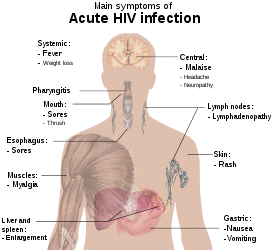 A diagram of a human torso labelled with the most common symptoms of an acute HIV infection