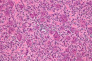 Giant cell tumour of bone - high mag.jpg
