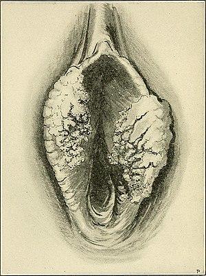 The Principles and practice of gynecology - for students and practitioners (1904) (14581300578).jpg