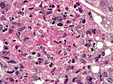 Histoplasma pas-d.jpg