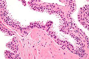 High-grade prostatic intraepithelial neoplasia high mag.jpg