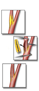 Blausen 0172 CarotidEndarterectomy.png