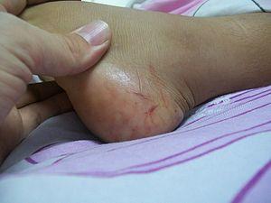 Snake Bite injury.jpg