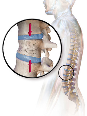 Blausen 0250 CompressionFracture Vertebrae.png