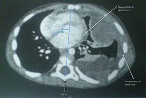 Undifferentiated soft tissue sarcoma in left lung of young child.jpg