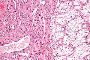 Clear cell renal cell carcinoma high mag.jpg