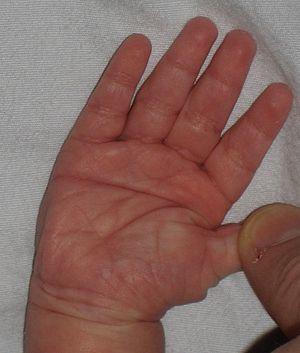 Simian crease2.jpg