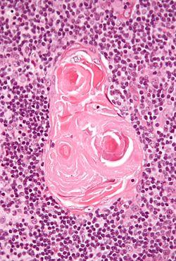 Thymic corpuscle.jpg
