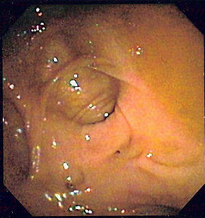 Diverticulosis 2.jpg