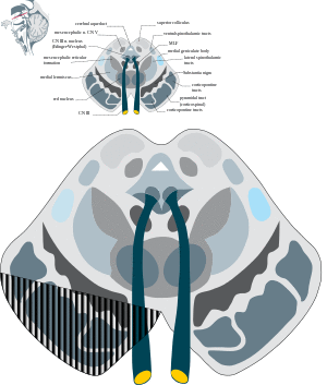 Weber's syndrome.svg