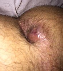 Perianal abscess