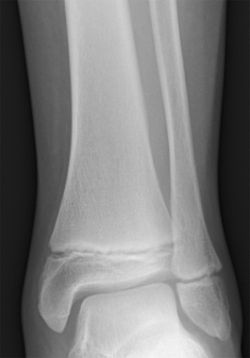 Tib fib growth plates.jpg