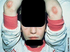 Dermatomyositis4.jpg