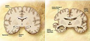 Alzheimer's disease brain comparison.jpg