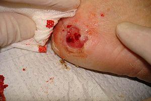 Neuropathic heel ulcer.jpg