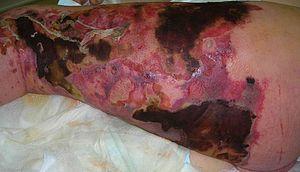 Necrotizing fasciitis left leg.JPEG