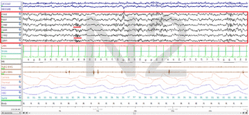 Stage N2 Sleep. EEG highlighted by red box. Sleep spindles highlighted by red line.