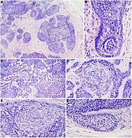 Micrographs of trichoblastoma.jpg