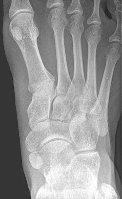 Os tibiale externum - Roe Fuss.jpg