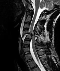Cervical Spine MRI (T2W).jpg
