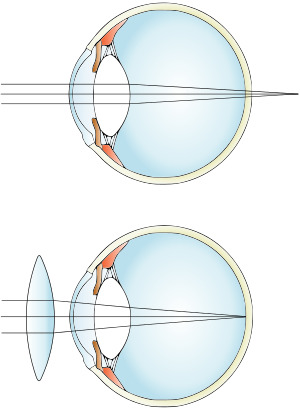Hypermetropia color.svg