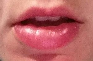 Actinic Cheilitis Photo.jpg
