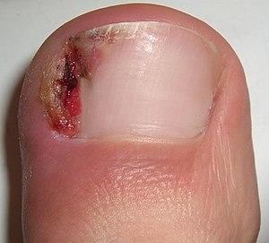 Ingrown nail 002 cropped.jpg