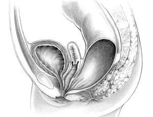 Persistent cloaca.jpg