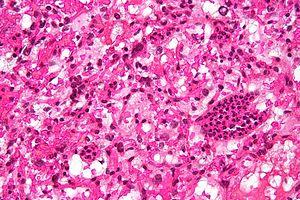 Cerebellar hemangioblastoma high mag.jpg