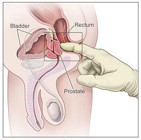 Digital rectal exam nci-vol-7136-300.jpg