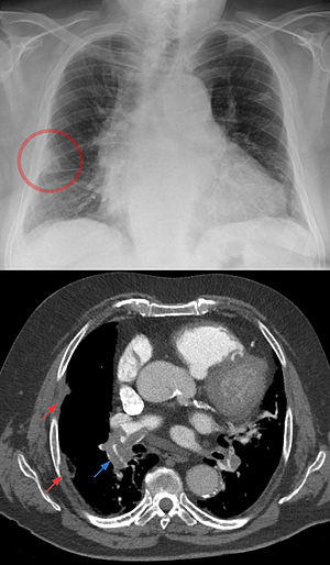 Hampton hump bei schwerer Lungenembolie - Roe Thorax und CT axial.jpg