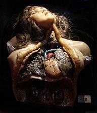 Busto in cera sulla tubercolosi polmonare, xix secolo (facoltà di medicina di montpellier).jpg