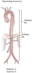 Aortic dissection of DeBakey type III.png