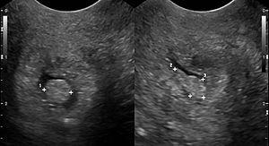 Cervical polyp.jpg