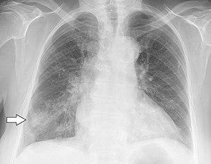 Chest X-ray in influenza and Haemophilus influenzae - annotated.jpg