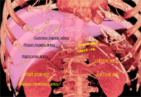 3D rendered CT of abdominal aortic branches and kidneys.svg