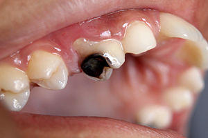 Dental Caries Cavity 2.JPG