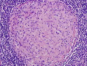 Granuloma mac.jpg