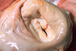 Mitral stenosis, gross pathology 20G0015 lores.jpg